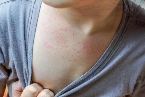 Measles on skin